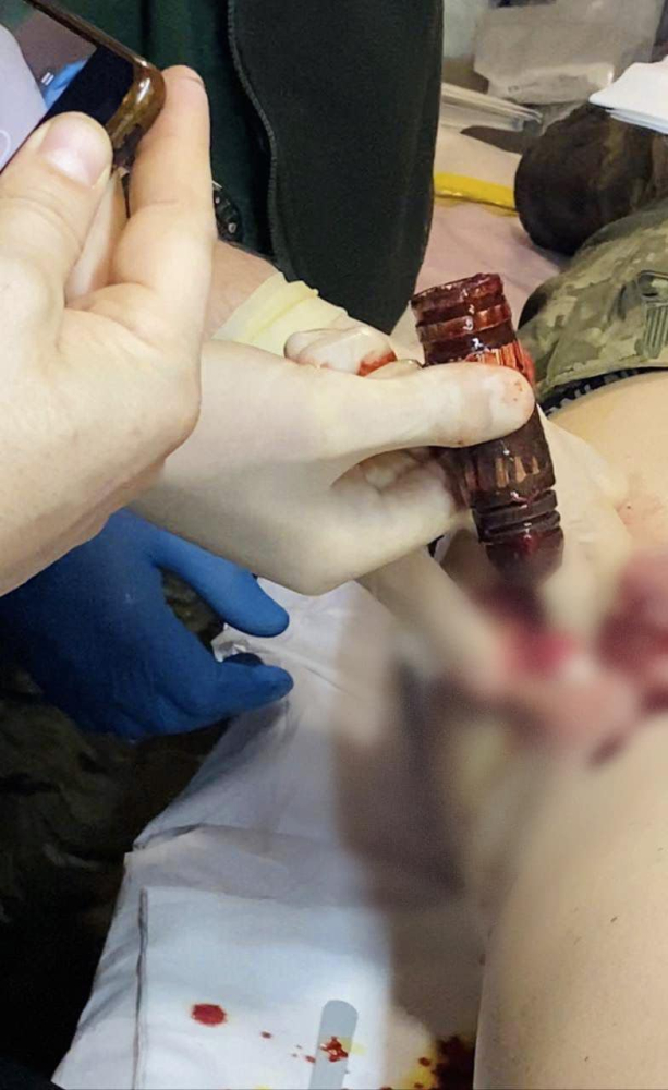 Медики дістали з тіла пораненого захисника бойову частину бронебійного снаряду типу ВОГ